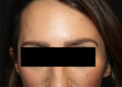 Botox and Dysport Before & After Patient #20108