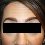 Botox and Dysport Before & After Patient #20108