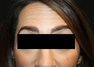 Botox and Dysport Before & After Patient #20108