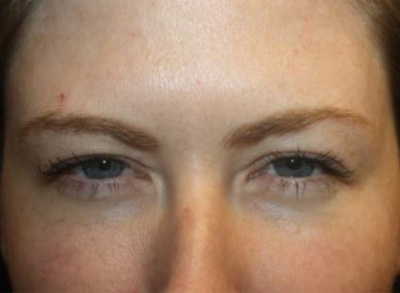 Botox and Dysport Before & After Patient #20111