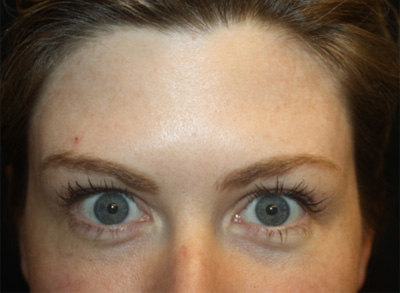 Botox and Dysport Before & After Patient #20111