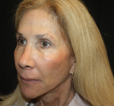 Facelift Before & After Patient #23575