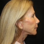 Facelift Before & After Patient #23575