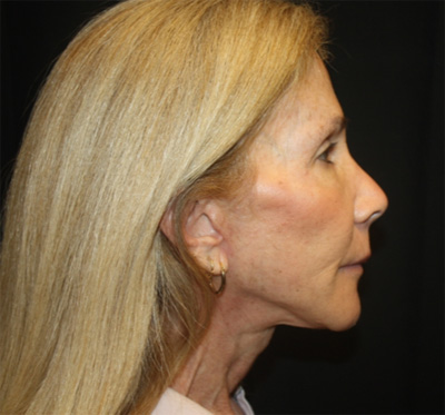 Facelift Before & After Patient #23575