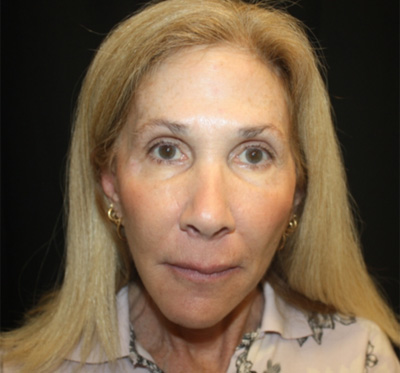 Facelift Before & After Patient #23575