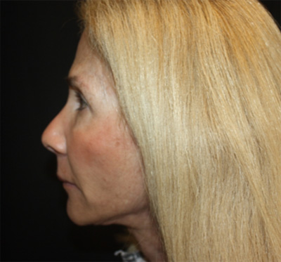 Facelift Before & After Patient #23575