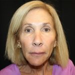 Facelift Before & After Patient #23575