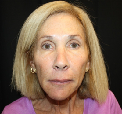 Facelift Before & After Patient #23575