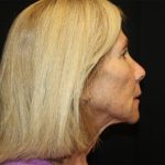 Facelift Before & After Patient #23575