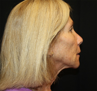 Facelift Before & After Patient #23575
