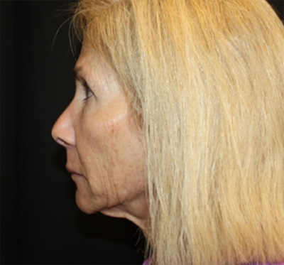 Facelift Before & After Patient #23575