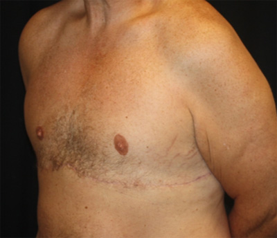 Gynecomastia Before & After Patient #21299