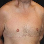 Gynecomastia Before & After Patient #21299