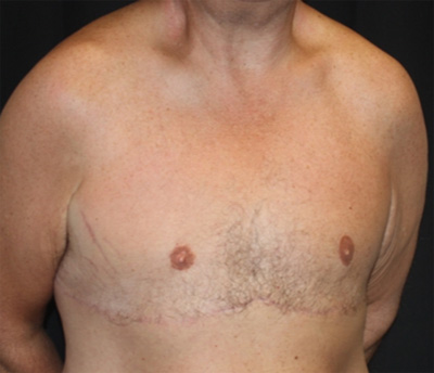 Gynecomastia Before & After Patient #21299