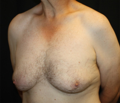 Gynecomastia Before & After Patient #21299