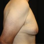 Gynecomastia Before & After Patient #21299