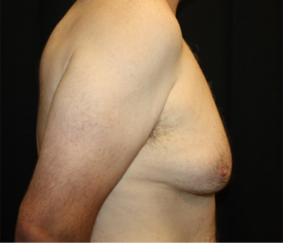 Gynecomastia Before & After Patient #21299