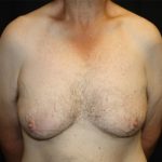 Gynecomastia Before & After Patient #21299