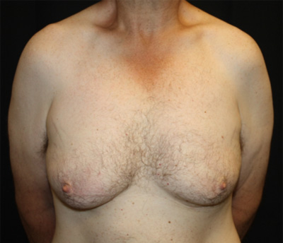 Gynecomastia Before & After Patient #21299