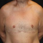 Gynecomastia Before & After Patient #21299