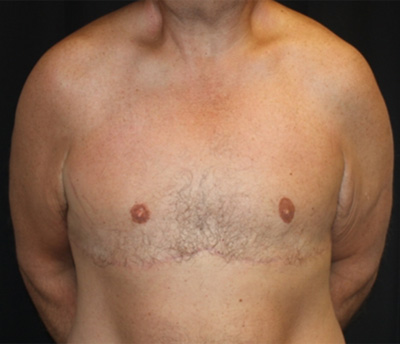 Gynecomastia Before & After Patient #21299