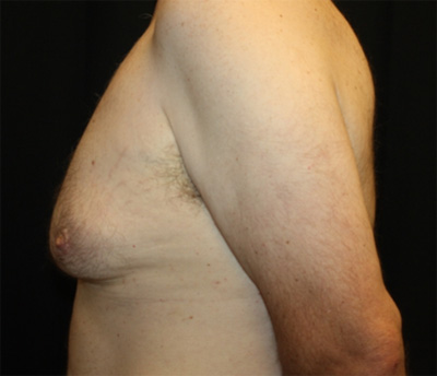 Gynecomastia Before & After Patient #21299