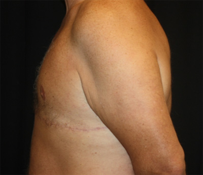 Gynecomastia Before & After Patient #21299