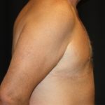 Gynecomastia Before & After Patient #21299
