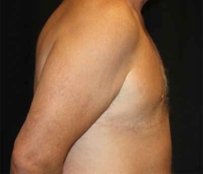 Gynecomastia Before & After Patient #21299