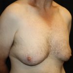 Gynecomastia Before & After Patient #21299