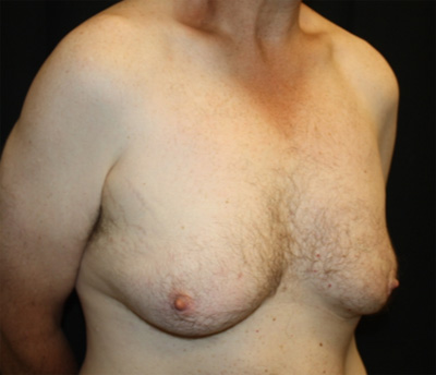 Gynecomastia Before & After Patient #21299