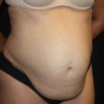 Tummy Tuck Before & After Patient #22467