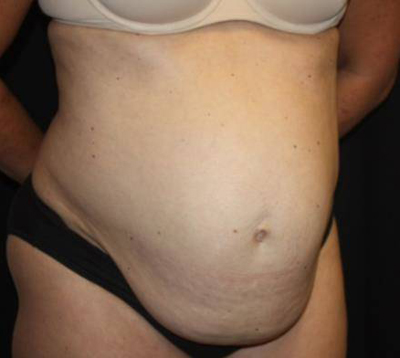 Tummy Tuck Before & After Patient #22467