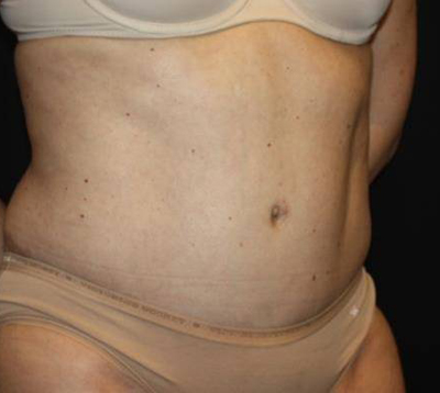 Tummy Tuck Before & After Patient #22467