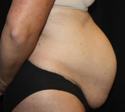 Tummy Tuck Before & After Patient #22467