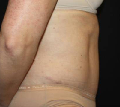 Tummy Tuck Before & After Patient #22467