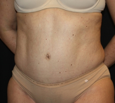 Tummy Tuck Before & After Patient #22467