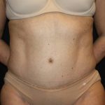 Tummy Tuck Before & After Patient #22467