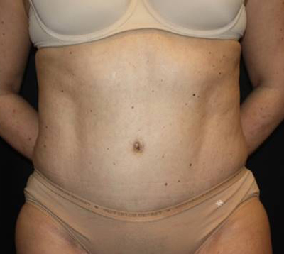 Tummy Tuck Before & After Patient #22467