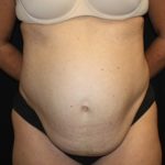 Tummy Tuck Before & After Patient #22467