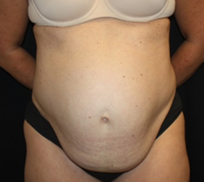 Tummy Tuck Before & After Patient #22467