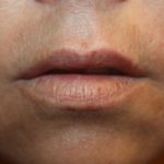 Injectable Fillers Before & After Patient #21351