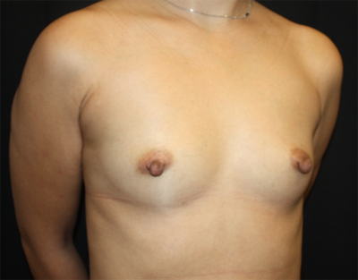 Breast Augmentation - Shaped Silicone Implants Before & After Patient #20497