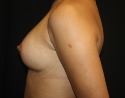 Breast Augmentation - Shaped Silicone Implants Before & After Patient #20497