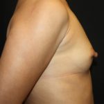 Breast Augmentation - Shaped Silicone Implants Before & After Patient #20497