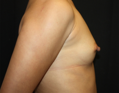 Breast Augmentation - Shaped Silicone Implants Before & After Patient #20497