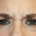 Botox and Dysport Before & After Patient #20114
