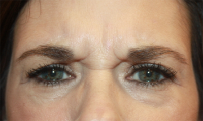 Botox and Dysport Before & After Patient #20114