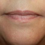 Injectable Fillers Before & After Patient #21352