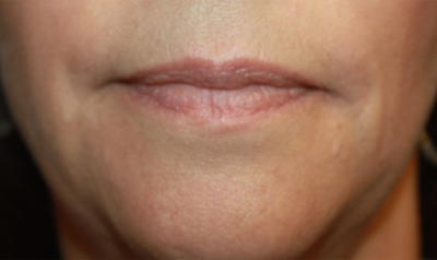 Injectable Fillers Before & After Patient #21352